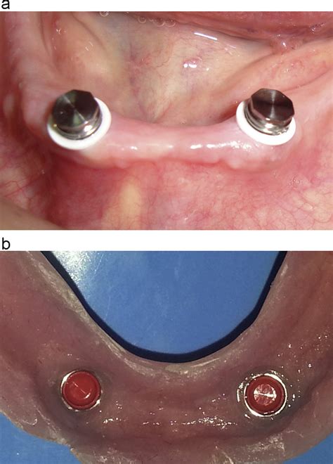 metal housing attachments denture|denture retention inserts.